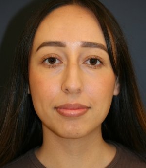 Rhinoplasty 222 - before - side