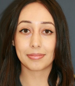 Rhinoplasty 222 - after - side