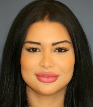 Rhinoplasty 223 - before - front