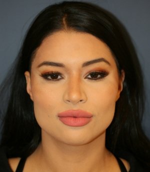 Rhinoplasty 223 - after - front