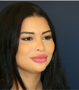 Rhinoplasty 223 - before - oblique