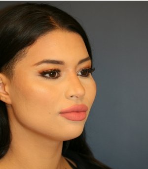 Rhinoplasty 223 - after - oblique