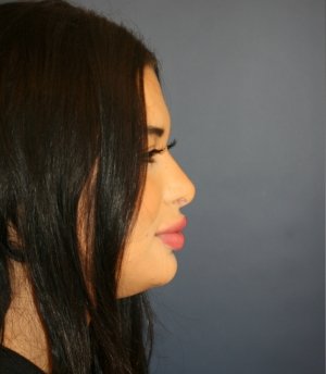 Rhinoplasty 223 - before - side