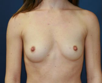 Breast Augmentation Case 44 - before - front