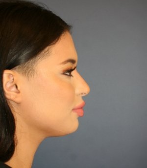 Rhinoplasty 223 - after - side