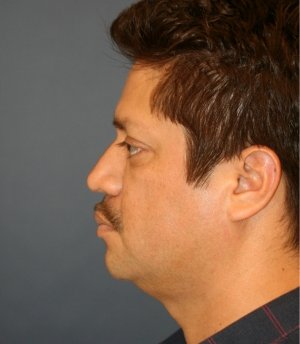 Rhinoplasty 224 - before - front