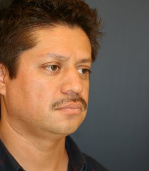 Rhinoplasty 224 - before - oblique