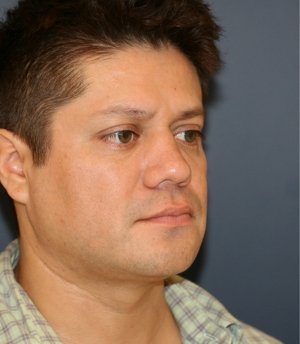 Rhinoplasty 224 - after - oblique