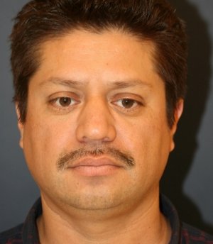 Rhinoplasty 224 - before - side