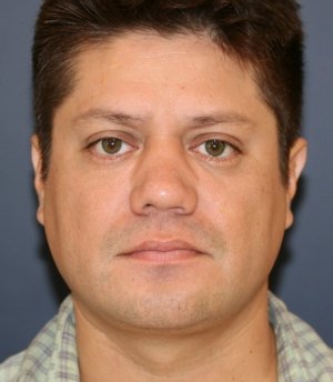 Rhinoplasty 224 - after - side