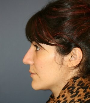Rhinoplasty 225 - before - front