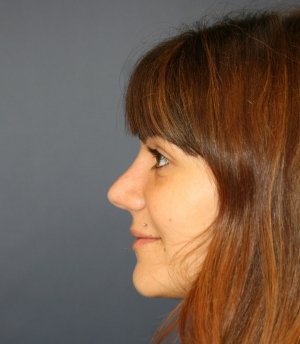 Rhinoplasty 225 - after - front