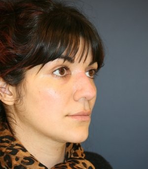 Rhinoplasty 225 - before - oblique