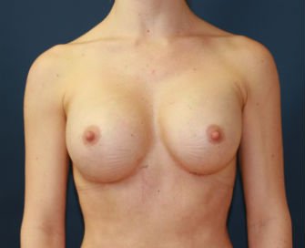 Breast Augmentation Case 44 - after - front