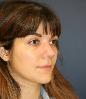 Rhinoplasty 225 - after - oblique