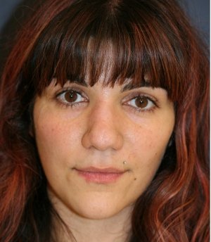 Rhinoplasty 225 - before - side