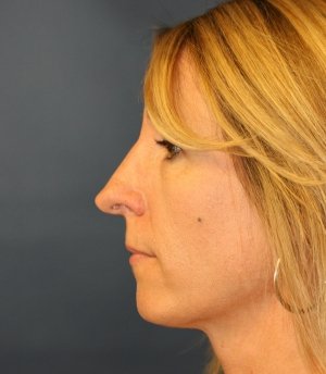 Rhinoplasty 226 - before - front