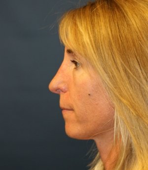 Rhinoplasty 226 - after - front