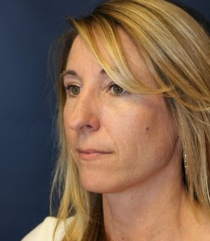 Rhinoplasty 226 - before - oblique