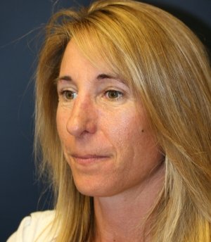 Rhinoplasty 226 - after - oblique