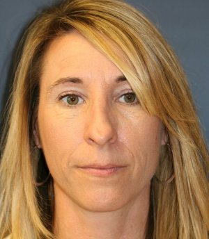 Rhinoplasty 226 - before - side