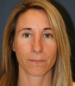 Rhinoplasty 226 - after - side