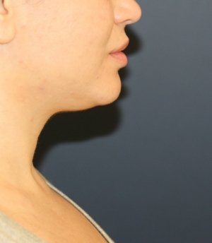 Neck Lipo San Diego - before - front