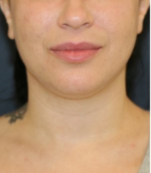 Neck Lipo San Diego - before - side