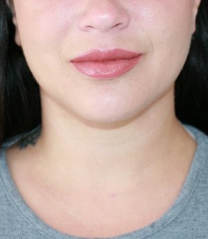 Neck Lipo San Diego - after - side