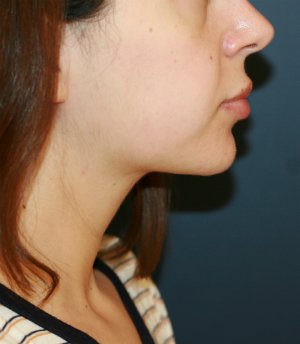 Lipo Neck and Face - after - front
