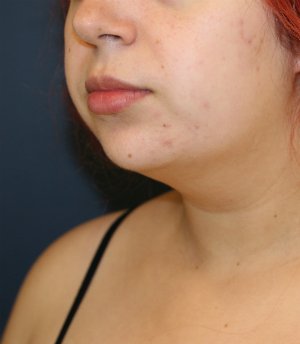 Lipo Neck and Face - before - oblique