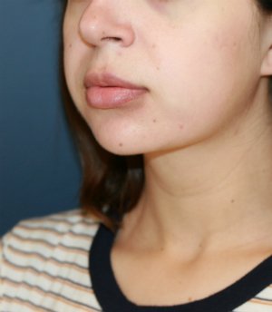Lipo Neck and Face - after - oblique