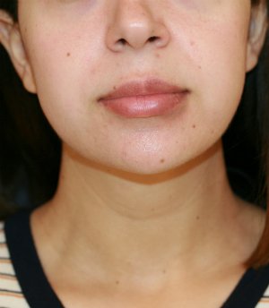 Lipo Neck and Face - after - side