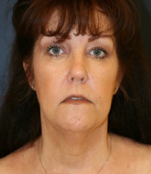 Necklift and Lips - before - side
