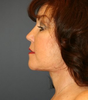 Necklift and Lips - after - left side