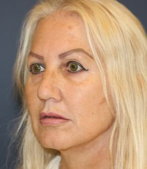 Rhinoplasty SD 227 - before - oblique
