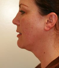 Liposuction of Neck - before - front