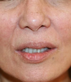 Upper Lip Lift 215 - before - front
