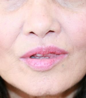 Upper Lip Lift 215 - after - front