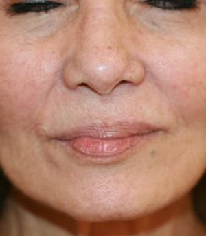 Upper Lip Lift 215 - before - bottom