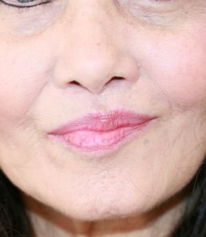 Upper Lip Lift 215 - after - bottom