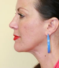 Liposuction of Neck - after - front