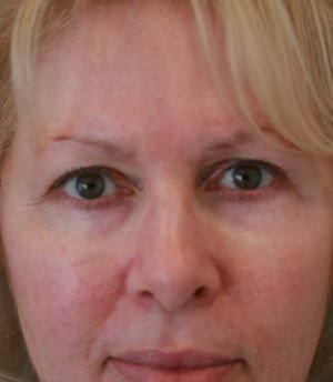 Eyelids 114 - before - front