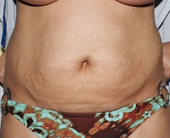 Tummy Tuck Case 11 - before - front