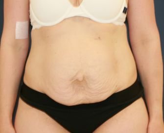 Tummy Tuck with Hernia Repair - before - front