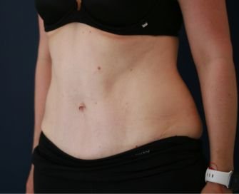 Tummy Tuck with Hernia Repair - after - right oblique