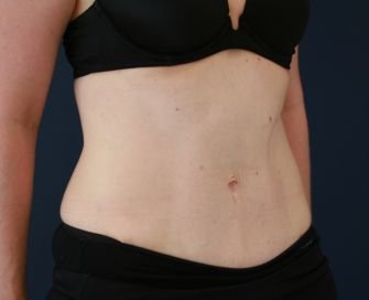 Tummy Tuck with Hernia Repair - after - left oblique