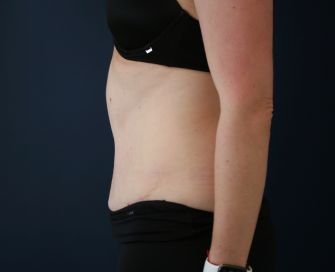Tummy Tuck with Hernia Repair - after - left side