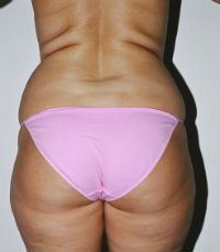 Liposuction Case 9 - before - front