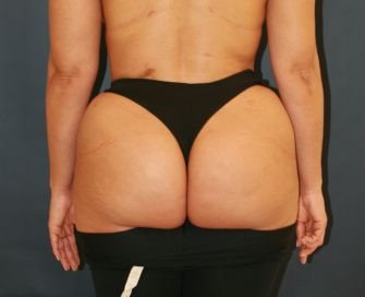 Fat to Buttocks - after - front